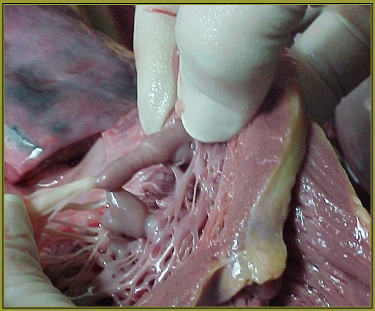 Imagen No. 4 - Fibrosis de la cuerda. Fusión y torsión de músculos papilares.